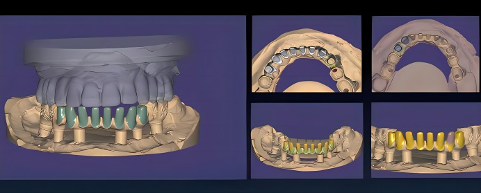 cad cam dental design software