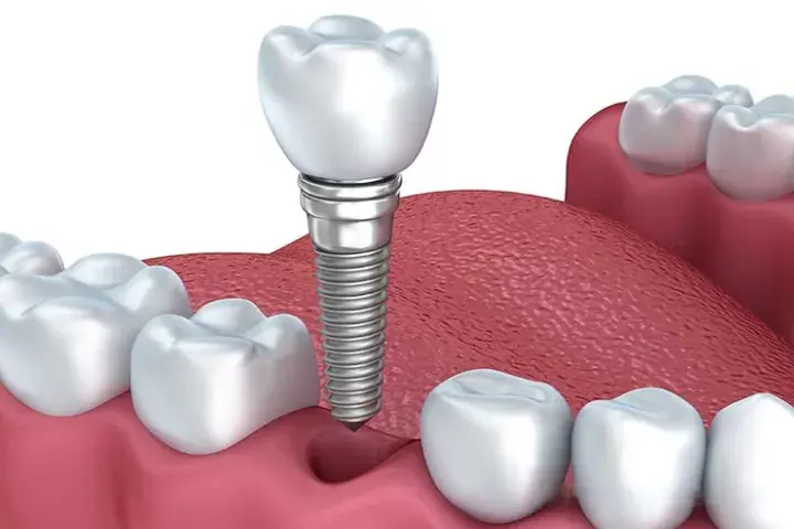 Dental Implant